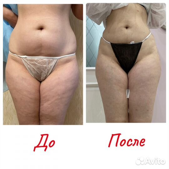 Липоаспирация