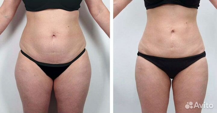 Эндосфера массаж -худеем с первого сеанса