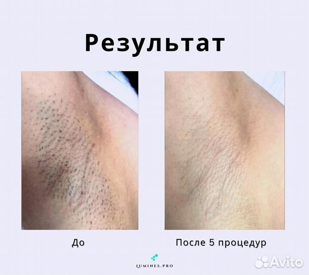 Аппарат для эпиляции Лю'Минес Max’One 1200W