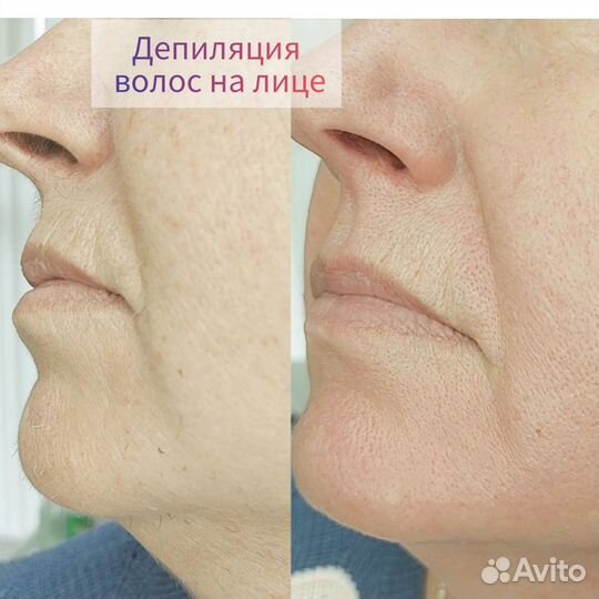 Депиляция/Обучение. Косметология. Кирсанов