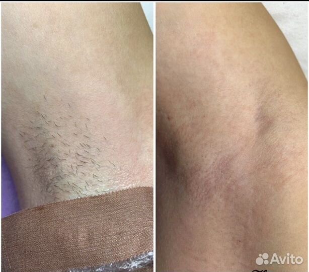 Электроэпиляция