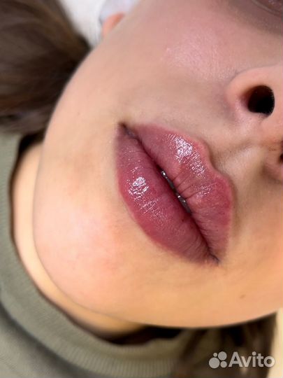 Увеличение губ,углы Джоли, биоревитализация,ботокс