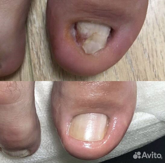 Педикюр / мозоли / вросшие ногти / трешины