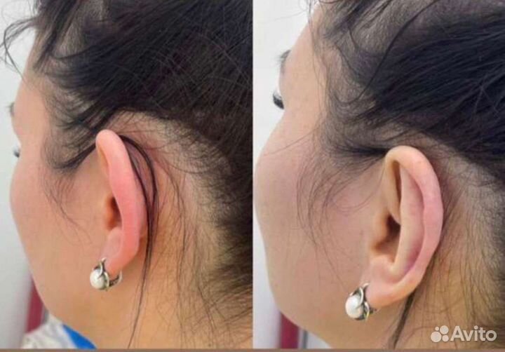 Отопластика нитевая