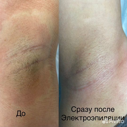 Электроэпиляция