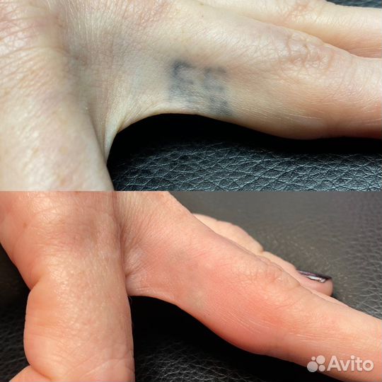 Удаление тату и татуажа