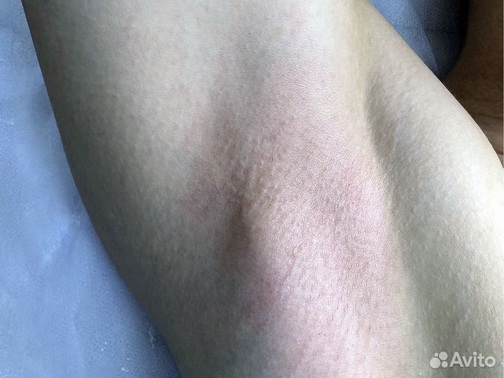 Депиляция, шугаринг