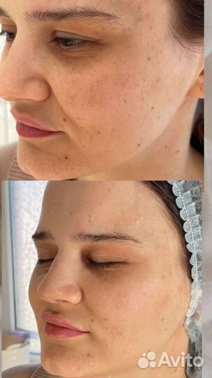 Ручной массаж, элос-Омоложение, элос-эпиляция