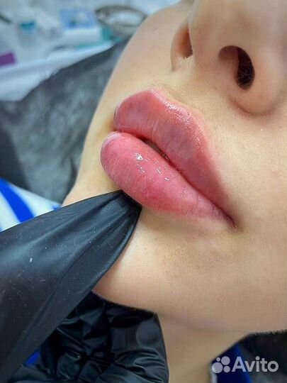Увеличение губ плоский бант, профиль джоли