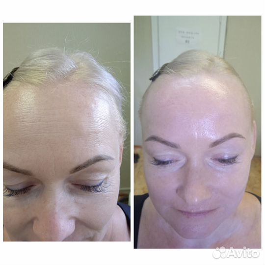 Массаж лица