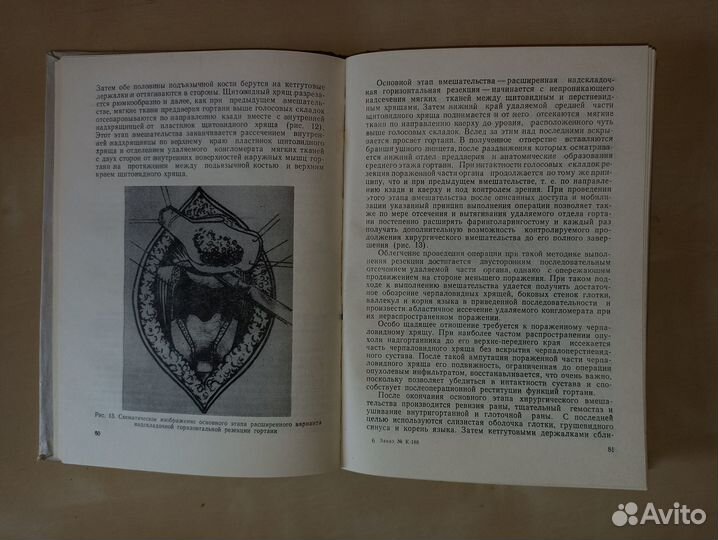 Дефекты глотки при хирургическом лечении рака горт