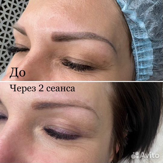 Удаление татуажа, тату, пилинг, лазерная эпиляция