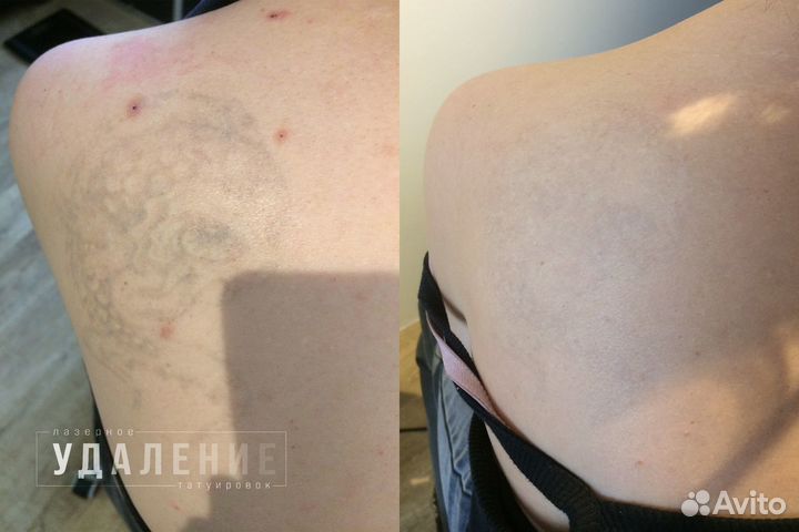 Лазерное удаление тату