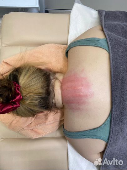 Безоперационно убираю – «вдовий горбик», «холку»