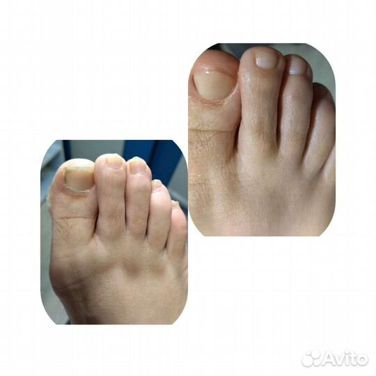 Лечебный педикюр любой сложности