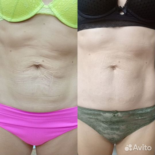 СМАС лифтинг