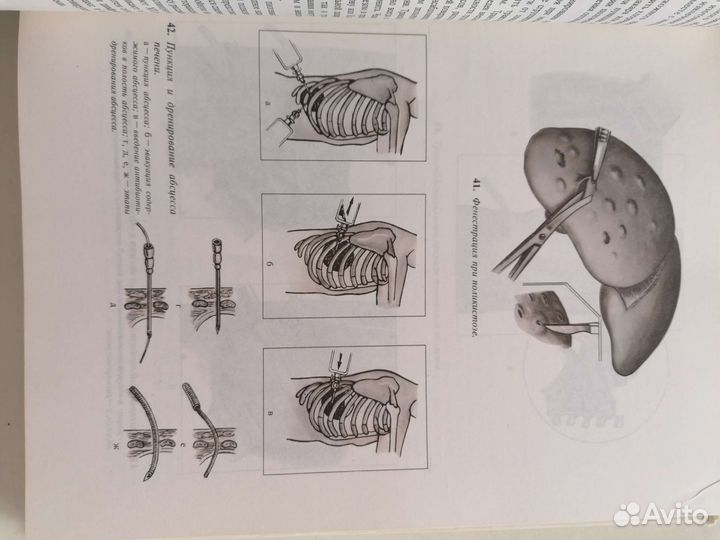 Атлас операций на печени, желчных путях и пр