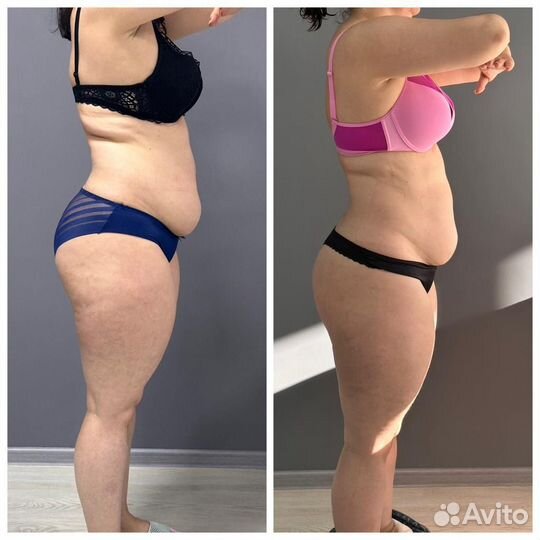 Антицеллюлитный массаж аппаратная коррекция LPG