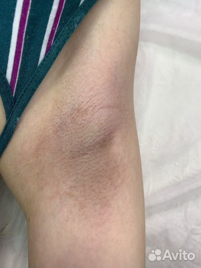 Шугаринг, восковая депиляция, эпиляция