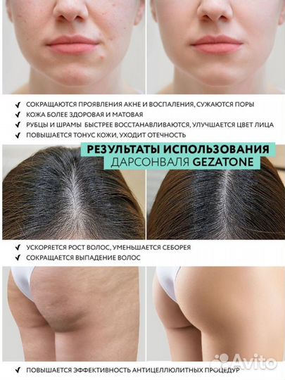 Дарсонваль