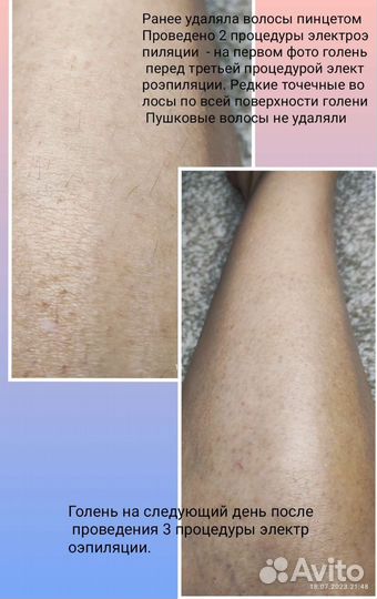 Электроэпиляция модель