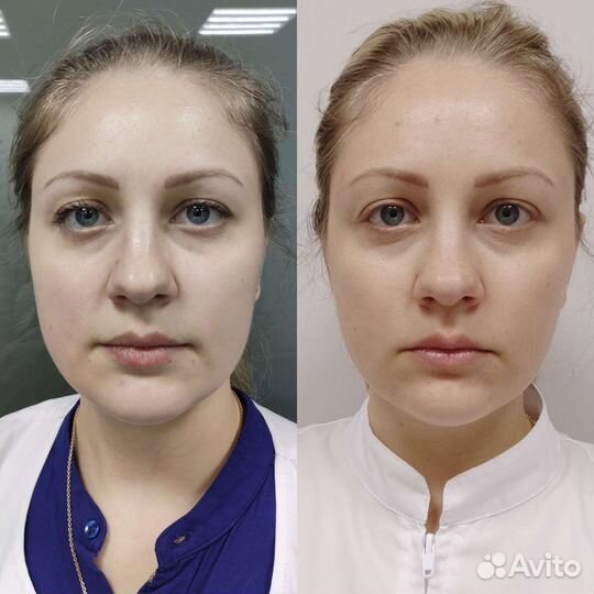 Смас лифтинг / smas лифтинг