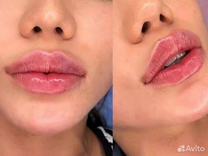 Увеличение губ, пиллинг, био, мезо