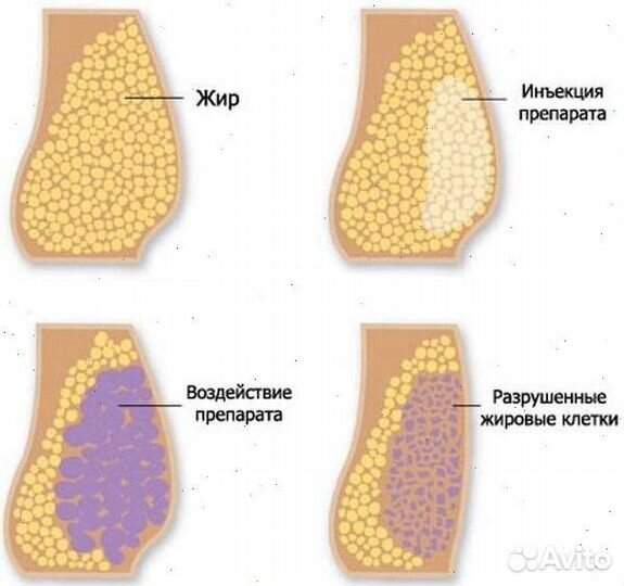 Липолитики / Похудение / Удаление растяжек