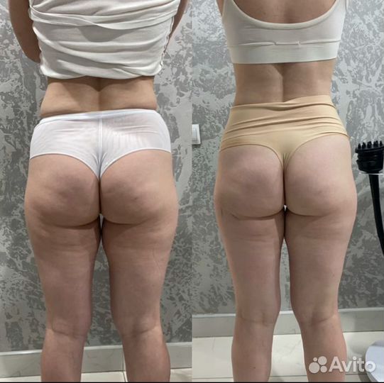 Массаж LPG(Аппаратный)