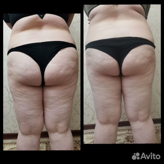 Антицеллюлитный массаж выезд на дом