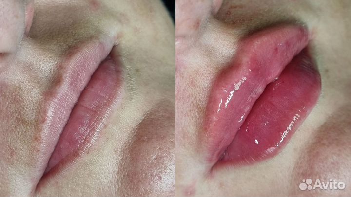 Увеличение губ