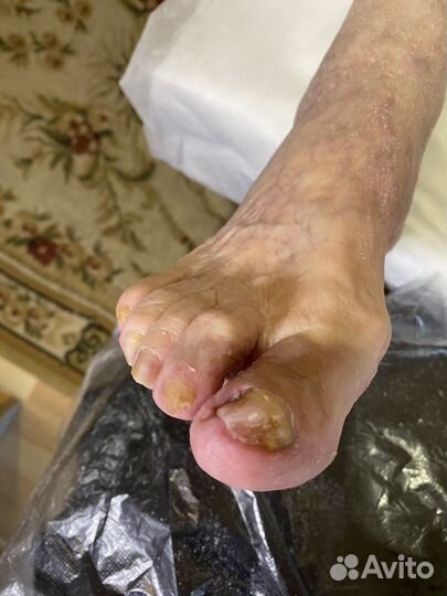 Педикюр подолог