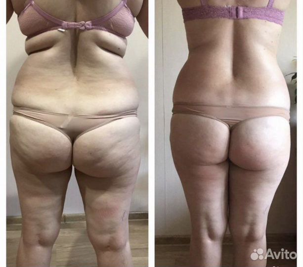 Массаж антицеллюлитный