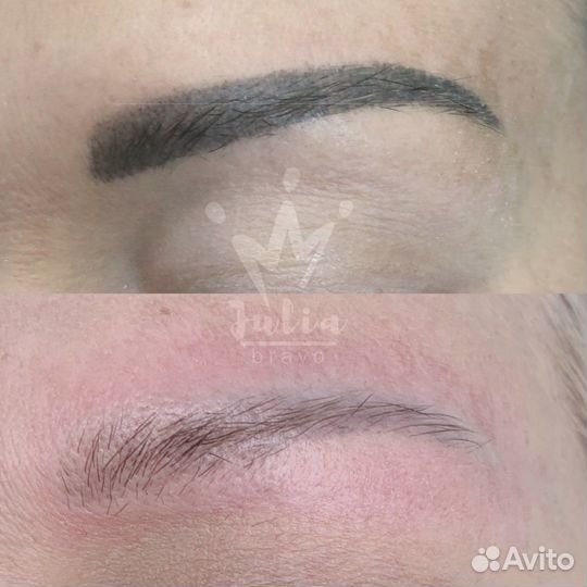 Лазерное удаление тату и татуажа