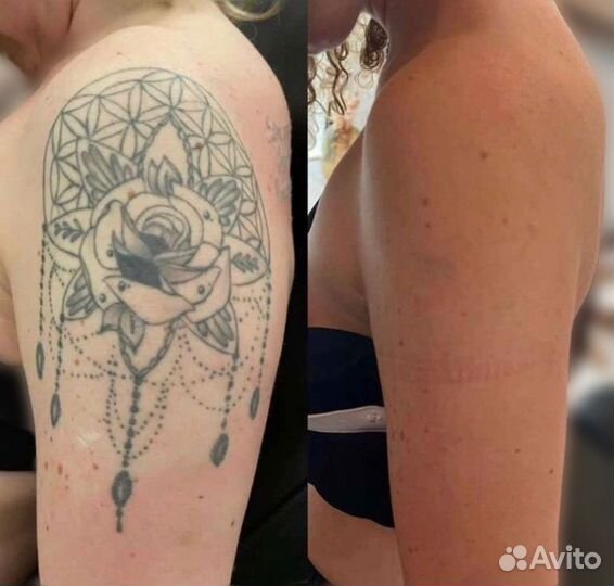 Полное удаление тату в спб