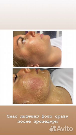 Смас лифтинг