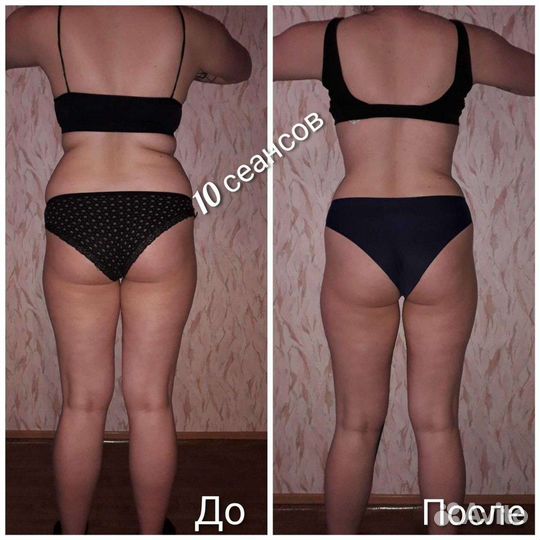 Антицеллюлитный массаж