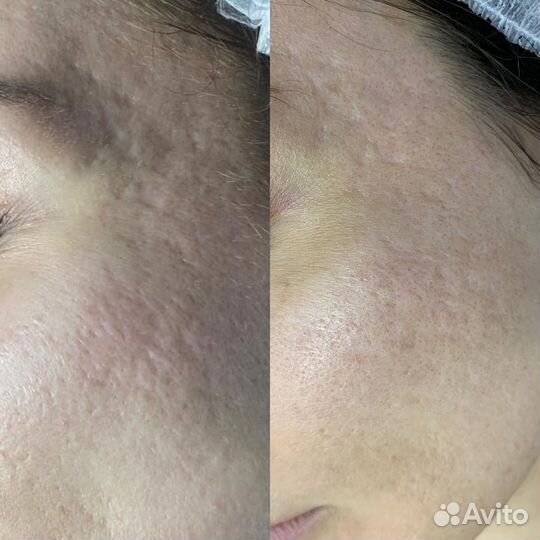 Пилинг для лица