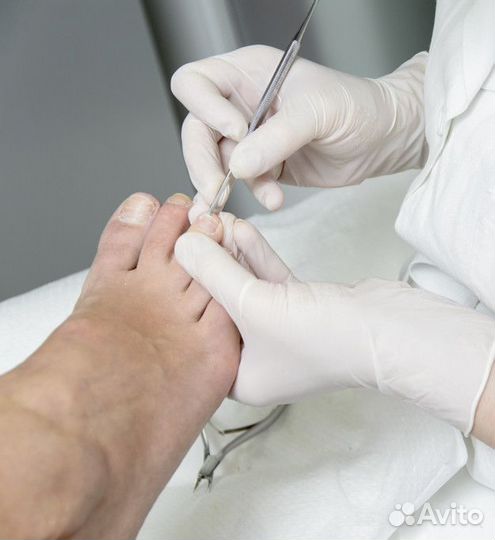 Лечебный педикюр подолог