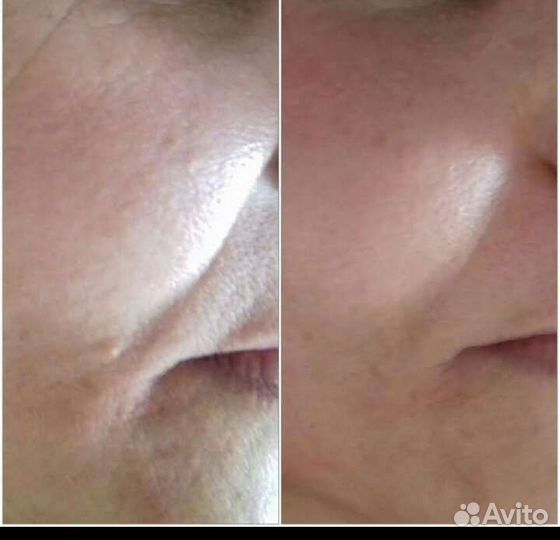 Чистка лица,пилинги