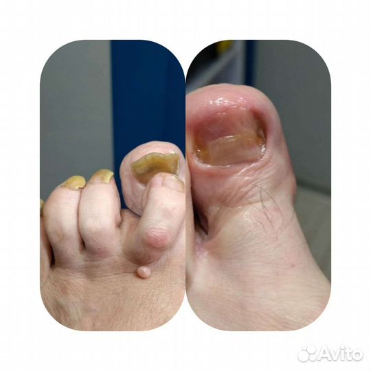 Лечебный педикюр любой сложности