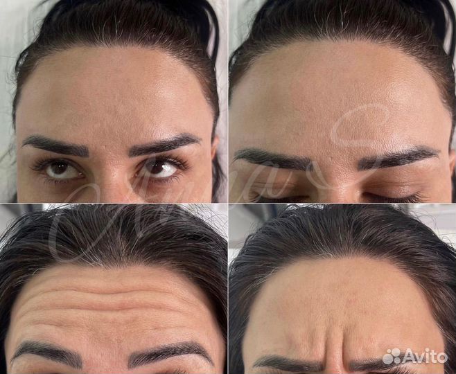 Ботокс для лица