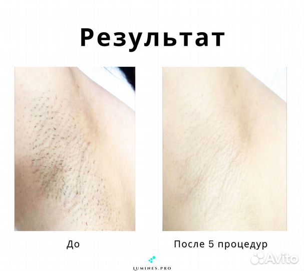 Диодный лазер Лю’минес Макс Ван 1200W