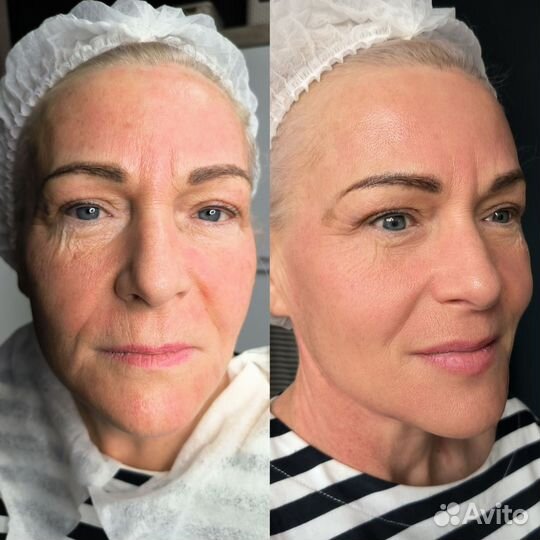 РФ лифтинг лица