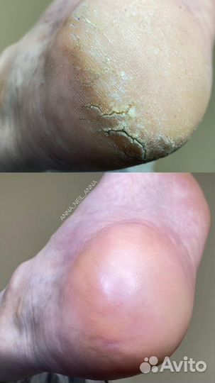 Подолог - Smart-педикюр ангарск