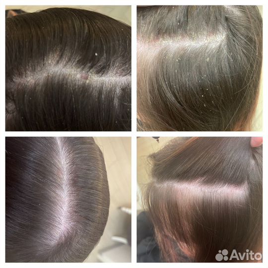 Пилинг для кожи головы