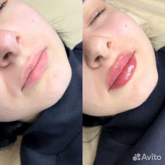 Увеличение губ