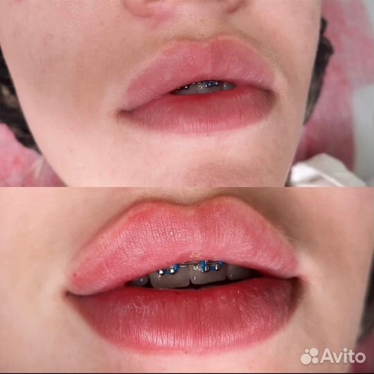 Увелечение губ;Ботулинотерапия