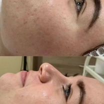 Пилинг лица/ желтый пилинг/ мезопилинг