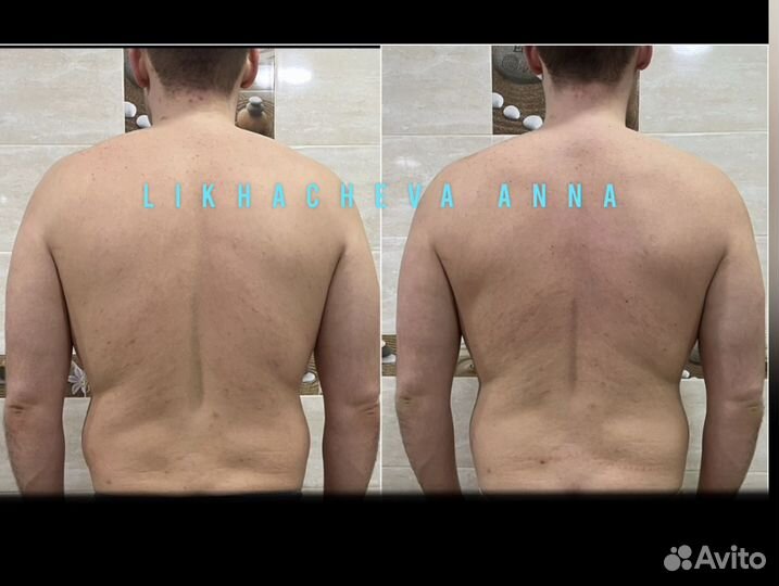 Остеопластика - мягкая правка тела и лица